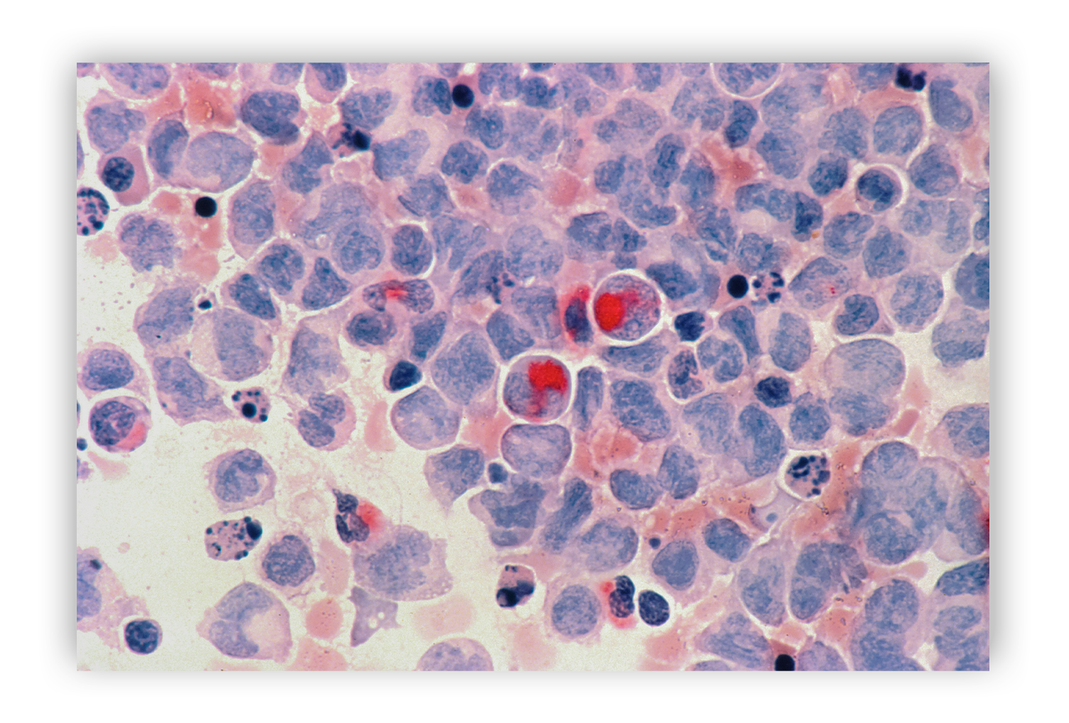 AI-Powered Breast Cancer Diagnosis